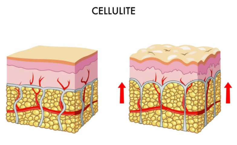 celulit