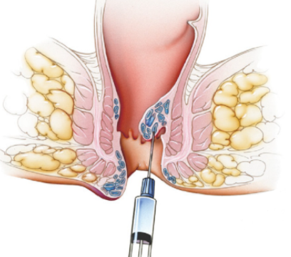 lechenie hemoroid