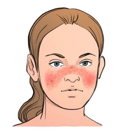 lice lupus