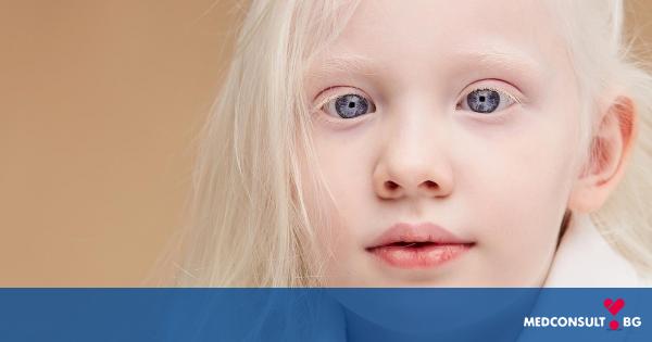 Албинизъм - как се проявява по кожата