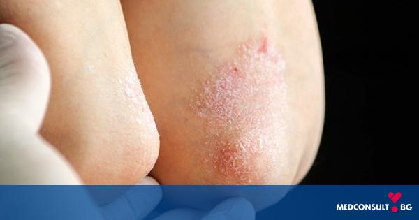 Псориазис - кожно заболяване