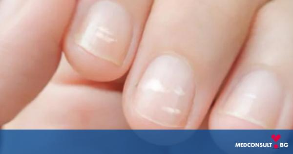 Какво означават белите петна по ноктите