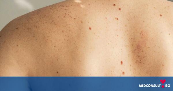 10 опасни мита за рака на кожата