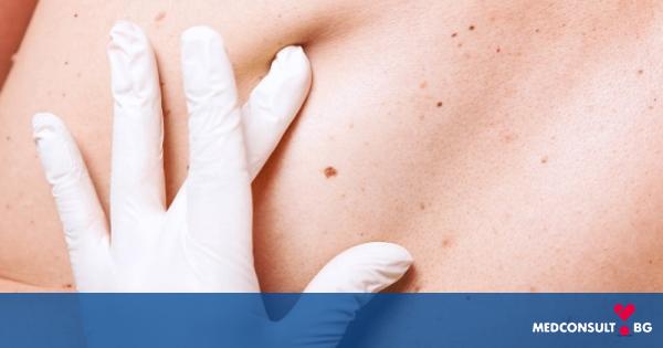 6 важни факта за рака на кожата, които могат да спасят  живота ви