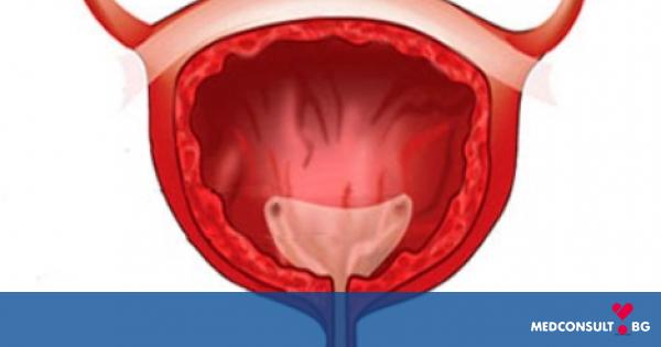 Какво знаете за рак на пикочния мехур