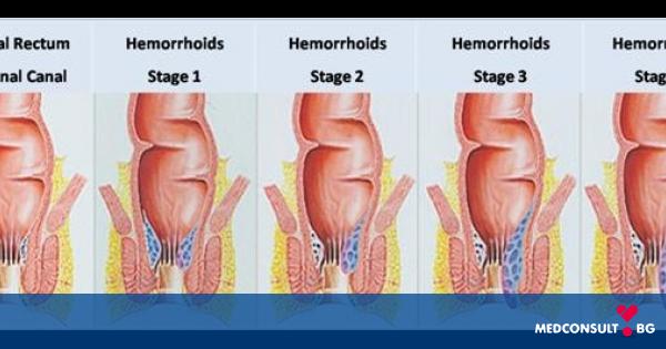Какво представляват хемороидите