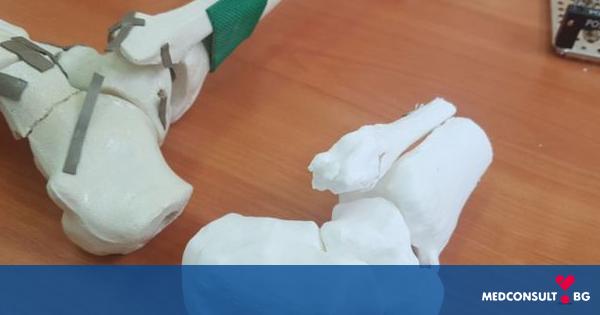 Оперираха с помощта на 3D принтер пациентка със сложно счупване във Варна