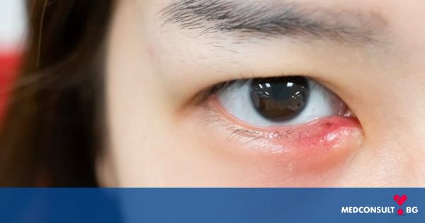 Как да лекуваме ечемик на окото