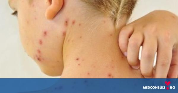 Здравните власти в Пловдив издирват деца без ваксинация за морбили