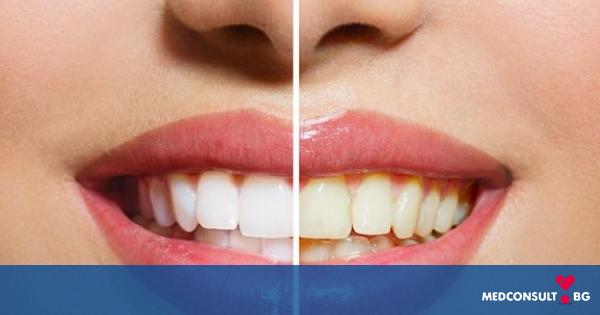 Избелване на зъби: кога и как да го направите