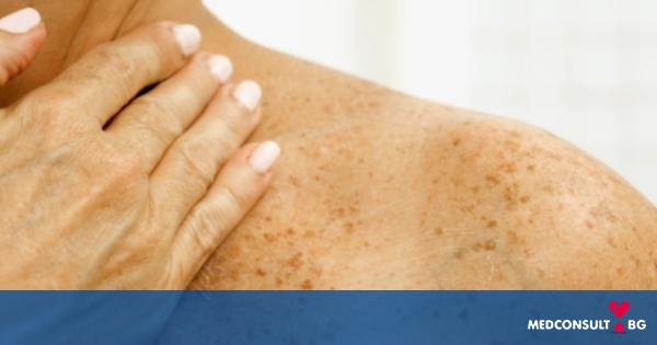 Рак на кожата - основни видове, рискови фактори и лечение