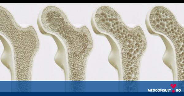Остеопороза - фрактура на костите