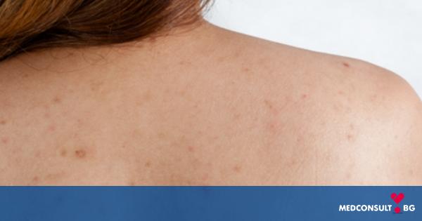 Акне по гърба и шията: защо се появява и как да се справим