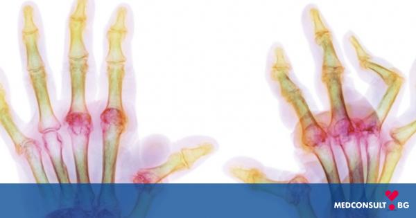 Ревматоиден артрит - едно от най-често срещаните възпалителни заболявания